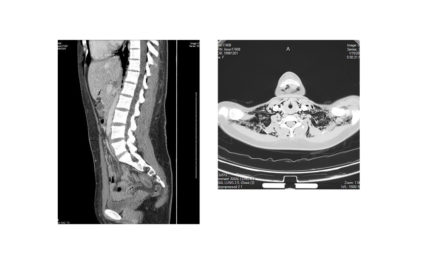 Case Report: Extensive Pneumomediastinum in a 20-Year-Old