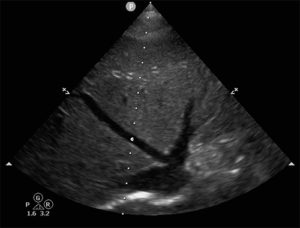 The VExUS Score: Fluid Status, Reconsidered | FCEP