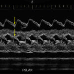 Ultrasound Zoom: On Cardiac Tamponade