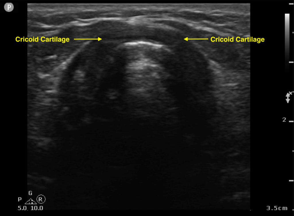 Airway Management with Point-of-Care-Ultrasound: A Breath of Fresh Air ...