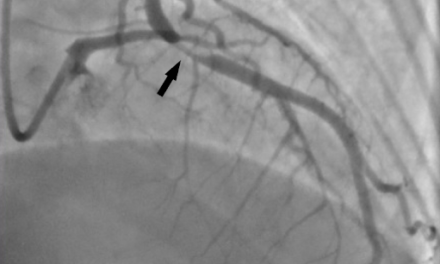 Heart Attacks in the Younger Population: A Case of Spontaneous Coronary Artery Dissection