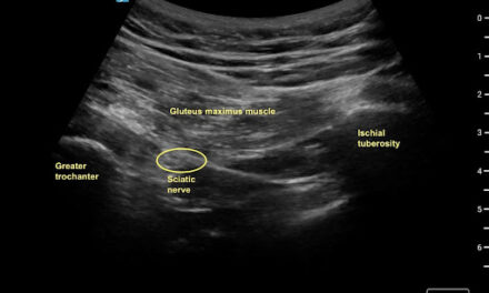 Ultrasound Guided Transgluteal Sciatic Nerve Block for Refractory Sciatica in the Emergency Department