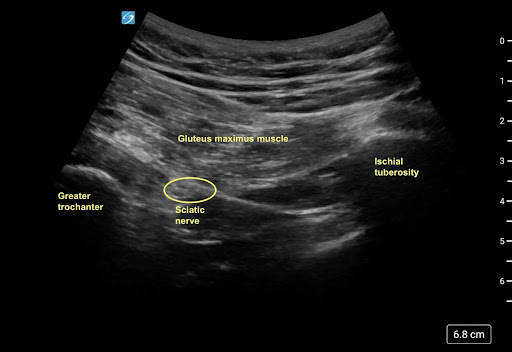 Ultrasound Guided Transgluteal Sciatic Nerve Block for Refractory Sciatica in the Emergency Department