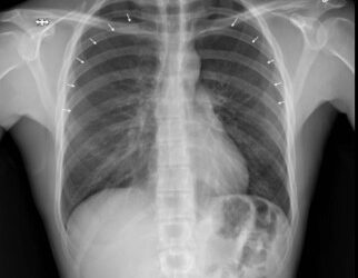 Bilateral Pneumothoraces After Trigger Point Injection Therapy: A Case Report